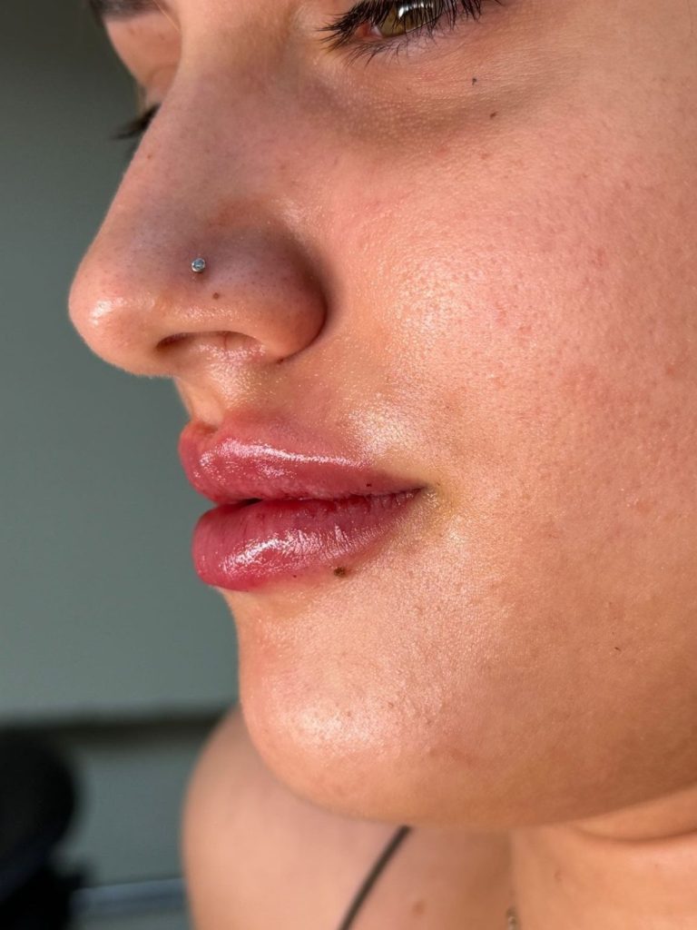 Voor- en na behandeling met lipfiller specialist van cosmedisch.com