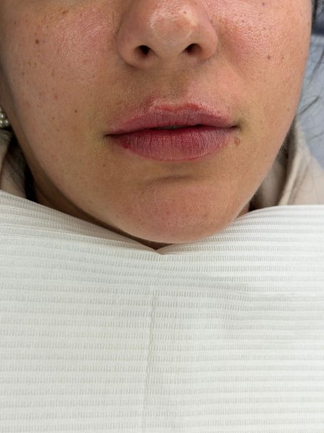 Voor- en na behandeling met lipfiller specialist van cosmedisch.com