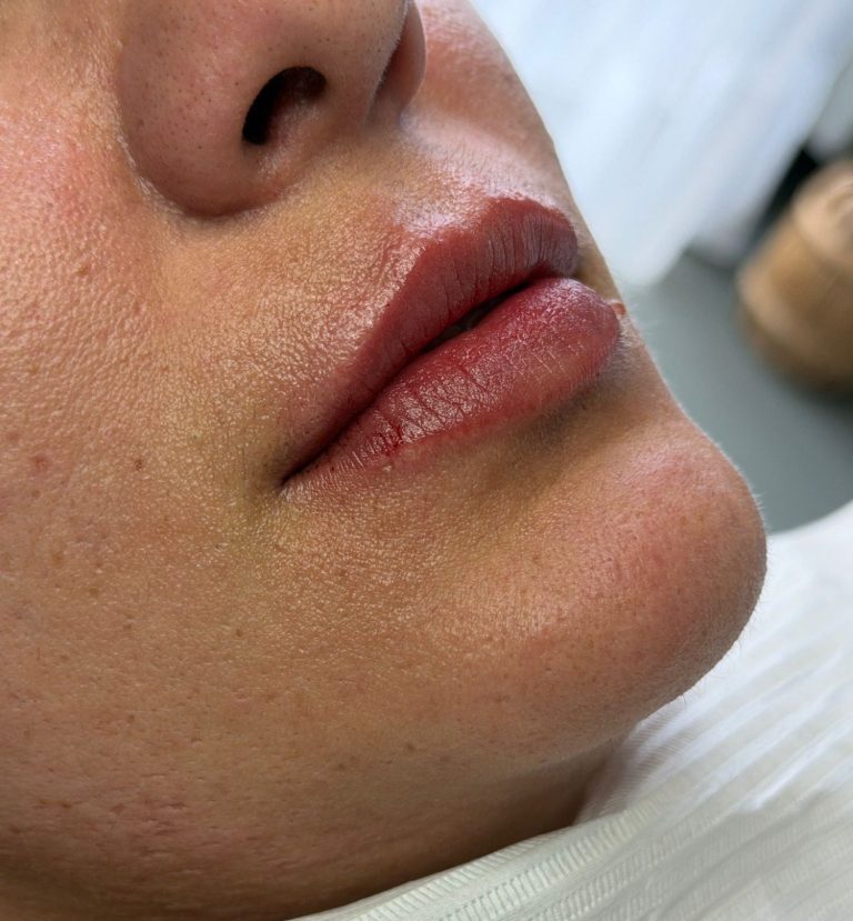 Voor- en na behandeling met lipfiller specialist van cosmedisch.com