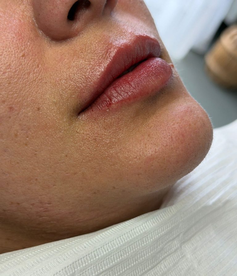Voor- en na behandeling met lipfiller specialist van cosmedisch.com