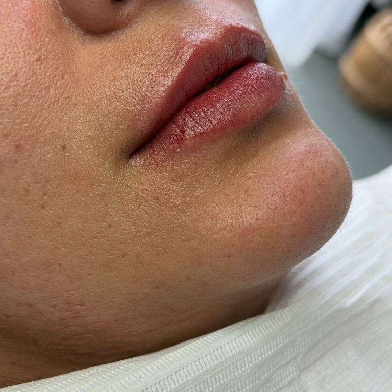 Voor- en na behandeling met lipfiller specialist van cosmedisch.com