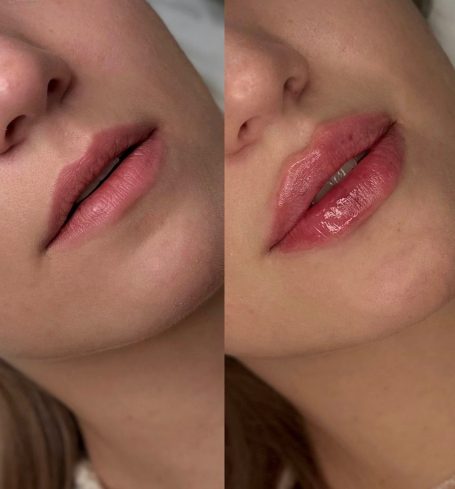 Vergelijking van lippen voor en na een lipfillerbehandeling, met een glanzende finish.