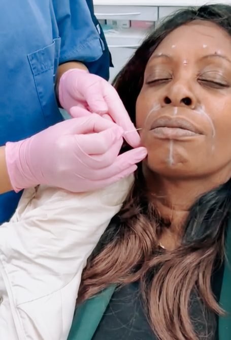 Lipfiller behandeling door arts van cosmedisch.com