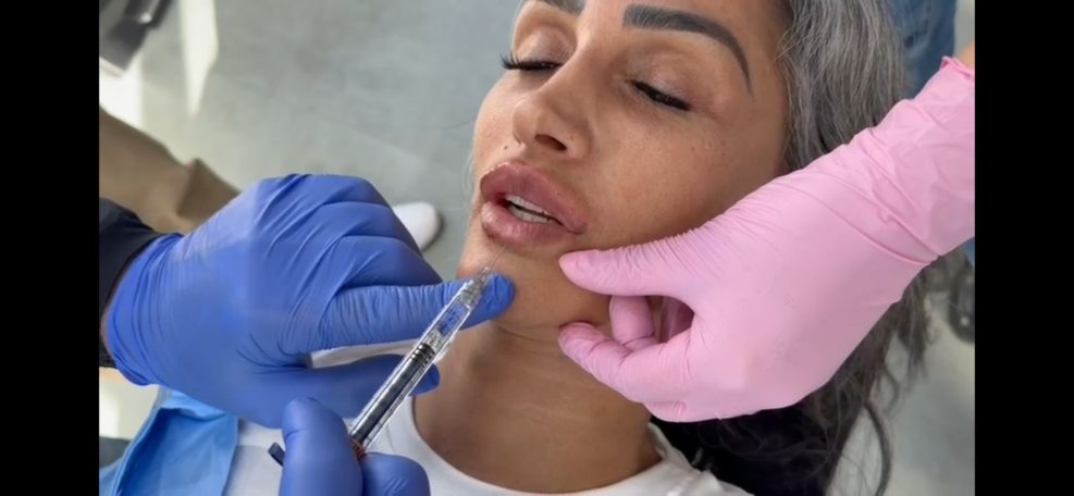 Lipfiller behandeling door arts van cosmedisch.com