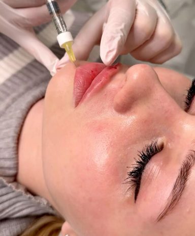 Een cliënte na een lipfillerbehandeling, met een glanzende finish. Door arts van cosmedisch.com