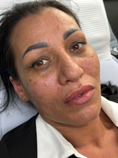 Voor- en na behandeling met lipfiller specialist van cosmedisch.com