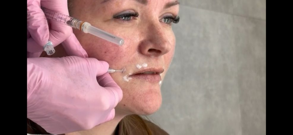 Lipfiller behandeling door arts van cosmedisch.com